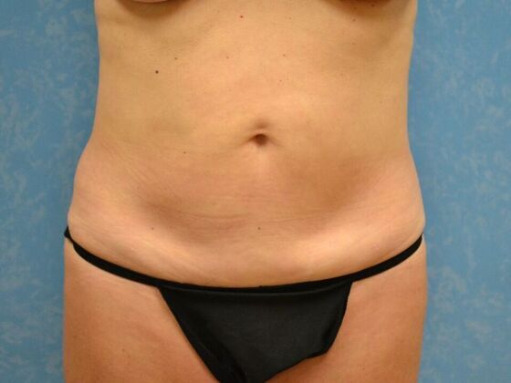 Tummy Tuck Case 1818, Sylvania, OH - Before