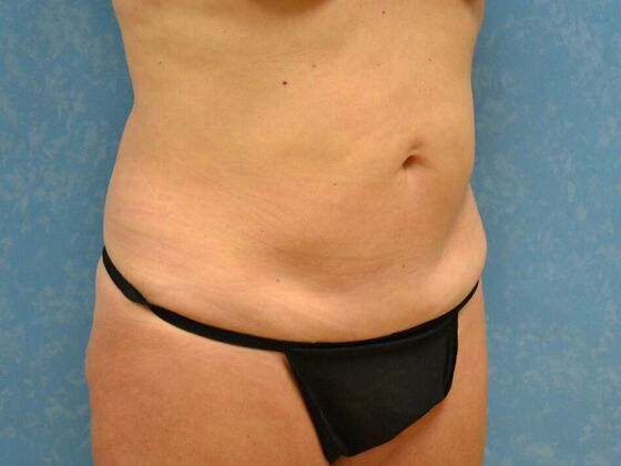 Tummy Tuck: Case 1818, Sylvania, OH - Before