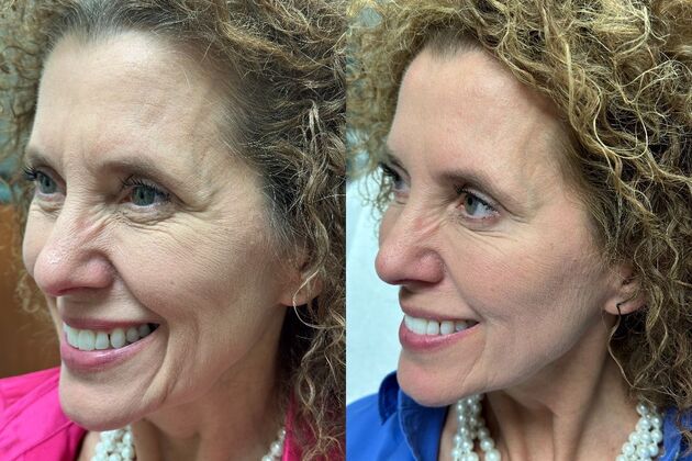 Injectables Botox, Dysport Neuromodulators Case 9 (34189)