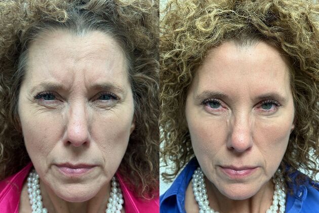 Injectables Botox, Dysport Neuromodulators: Case 9 (34189) - B&A frown softer
