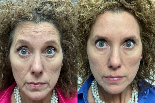 Injectables Botox, Dysport Neuromodulators: Case 9 (34189) - B&A forehead without deep expression lines, eyes look good