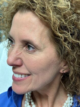 Injectables Botox, Dysport Neuromodulators: Case 9 (34189) - After Botox, crow