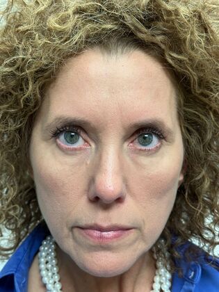 Injectables Botox, Dysport Neuromodulators: Case 9 (34189) - After, frown lines reduced