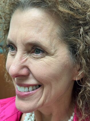 Injectables Botox, Dysport Neuromodulators: Case 9 (34189) - Before Botox, muscle lines beside left eye