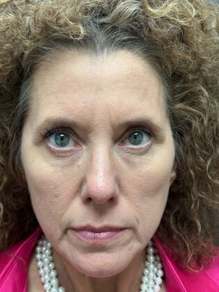 Injectables Botox, Dysport Neuromodulators: Case 9 (34189) - Before