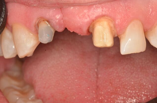 Bridges Case 11 - Before