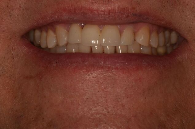 Bridges Case 11 - After