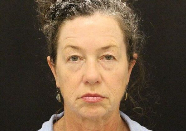 Face & Neck Lifts Case 31 - Before