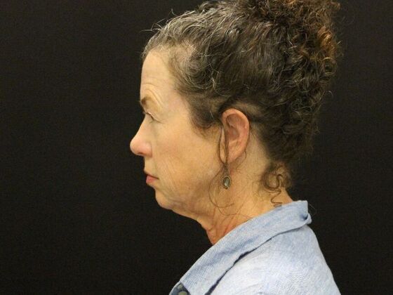 Face & Neck Lifts: Case 31 - Before