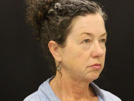 Face & Neck Lifts: Case 31 - Before