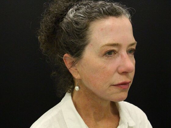 Face & Neck Lifts: Case 31 - After