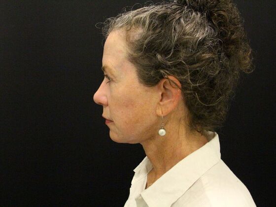 Face & Neck Lifts: Case 31 - After