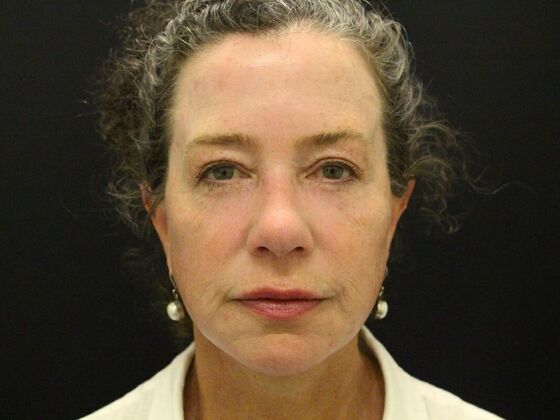 Face & Neck Lifts Case 31 - After