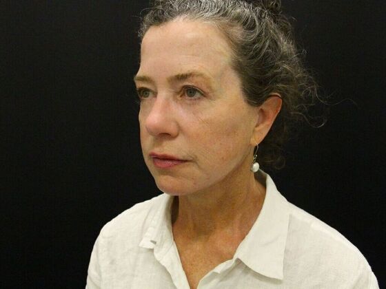 Face & Neck Lifts: Case 31 - After