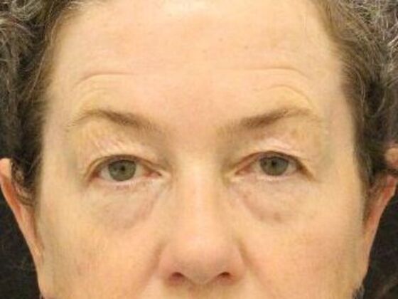 Eyelid Surgery Case 10 - Before