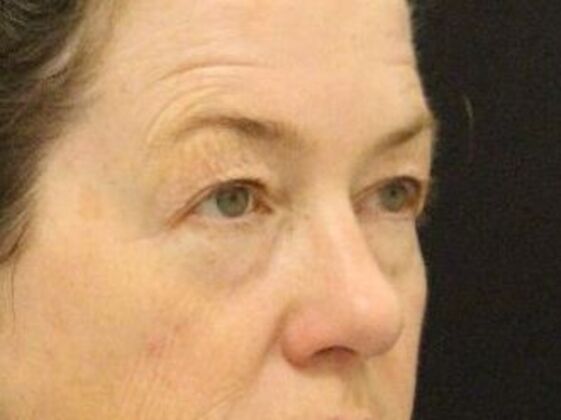 Eyelid Surgery: Case 10 - Before