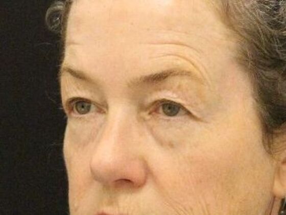 Eyelid Surgery: Case 10 - Before