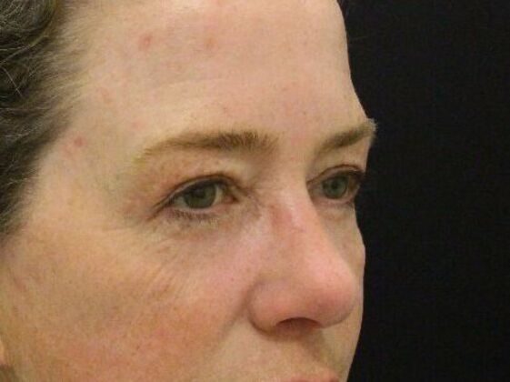 Eyelid Surgery: Case 10 - After