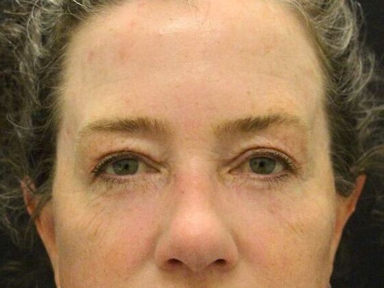 Eyelid Surgery Case 10 - After