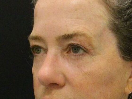 Eyelid Surgery: Case 10 - After