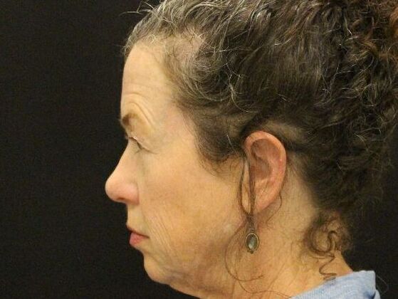 Non-Surgical: Case 5 - Before