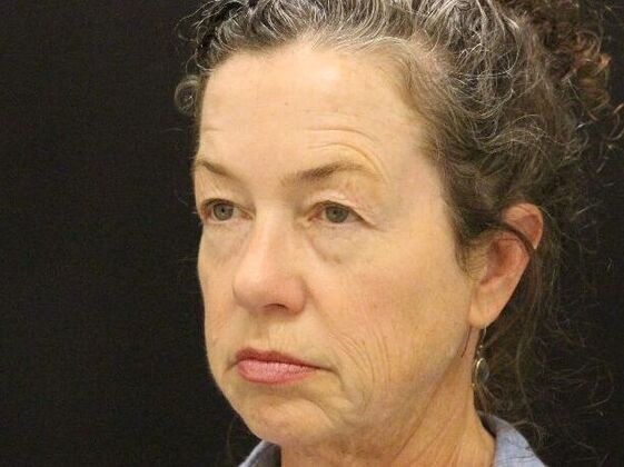 Non-Surgical: Case 5 - Before