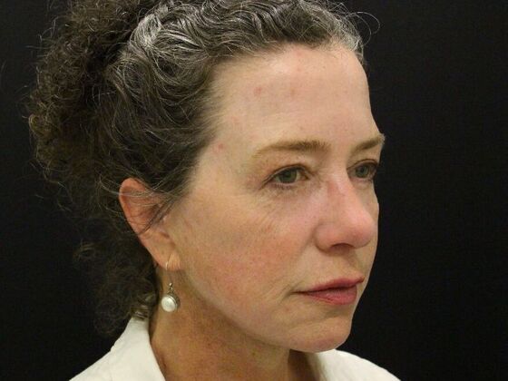 Non-Surgical: Case 5 - After