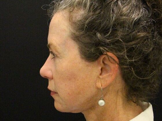 Non-Surgical: Case 5 - After