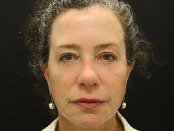 Non-Surgical: Case 5 - After