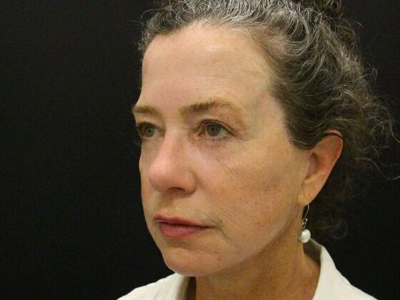 Non-Surgical: Case 5 - After