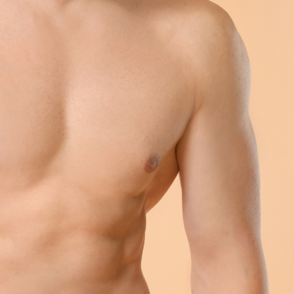 Gynecomastia Cases
