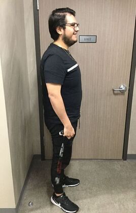 Gastric Sleeve: Case 11 - After