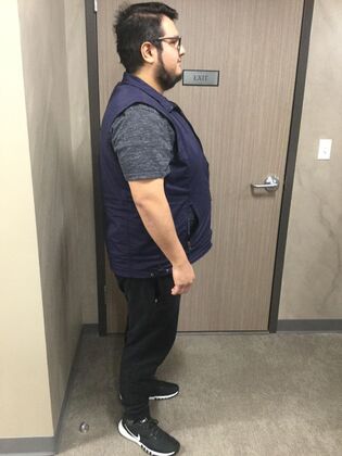 Gastric Sleeve: Case 11 - Before