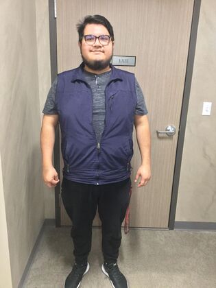 Gastric Sleeve: Case 11 - Before