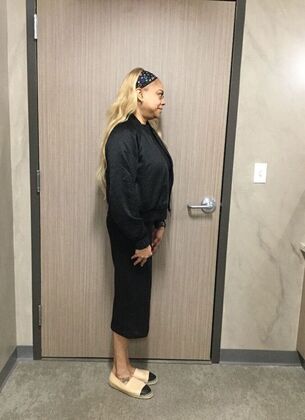 Laparoscopic Gastric Bypass: Case 4 - After