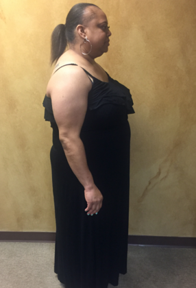 Laparoscopic Gastric Bypass: Case 4 - Before