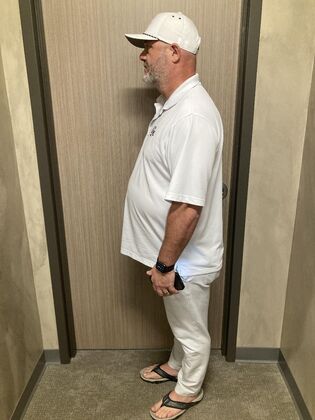 Laparoscopic Gastric Bypass: Case 5 - Before