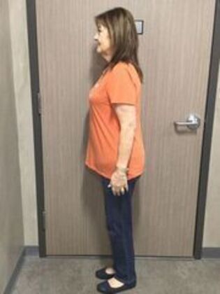 Laparoscopic Gastric Bypass: Case 6 - After