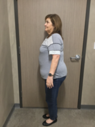 Laparoscopic Gastric Bypass: Case 6 - Before