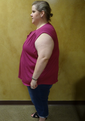 Revision Bariatric Surgery: Case 2 - Before