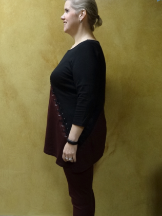 Revision Bariatric Surgery: Case 2 - After