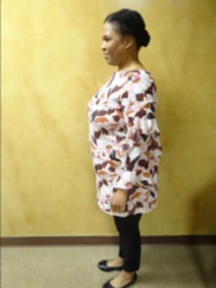 Revision Bariatric Surgery: Case 3 - Before