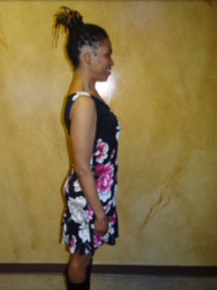 Revision Bariatric Surgery: Case 3 - After