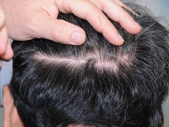 FUT Scars: Case 11 - After