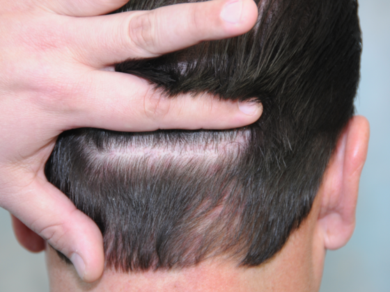 FUT Scars: Case 12 - After