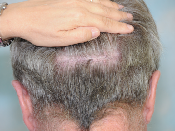 FUT Scars: Case 14 - After