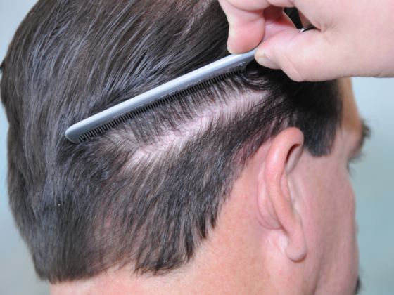 FUT Scars: Case 15 - After