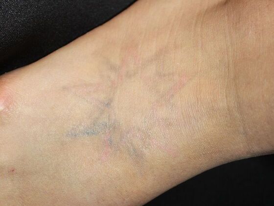 Laser Tattoo Removal Case 17 - After