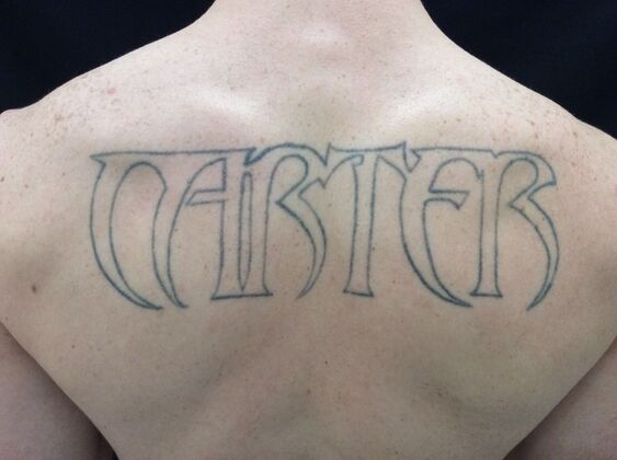 Laser Tattoo Removal Case 37 - Before