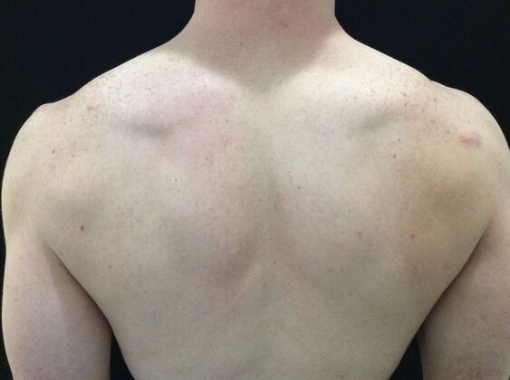 Laser Tattoo Removal Case 37 - After